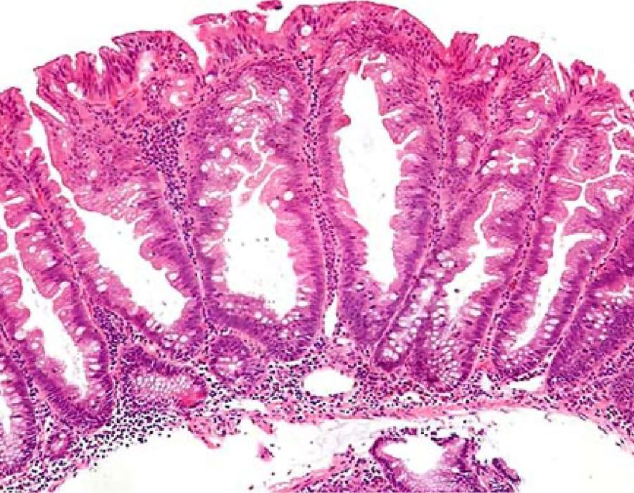 Sessile serrated polyps (SSP) and traditional serrated adenomas (TSA)