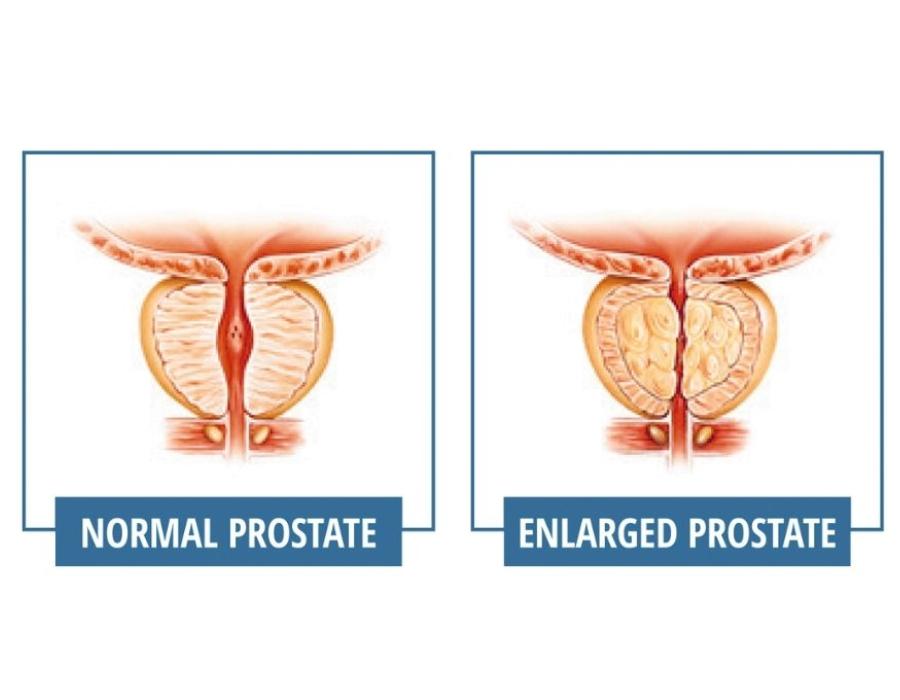 Normal versus enlarged prostate