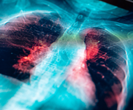 lung cancer screening