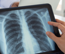 lung cancer screening physicians