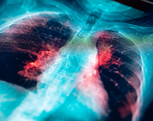 lung cancer screening