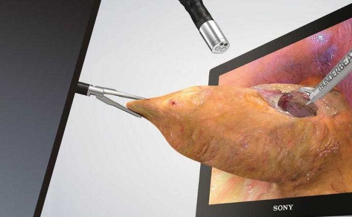 3D Laparoscopic Surgery